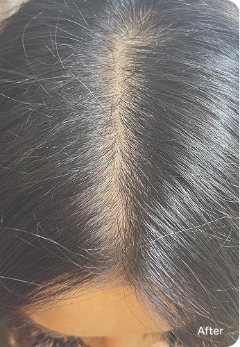 Female frontal/part — after Keravive