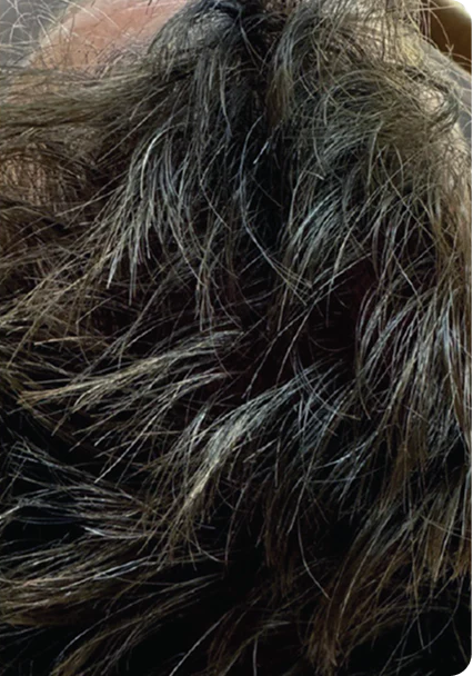 Male crown — after Keravive