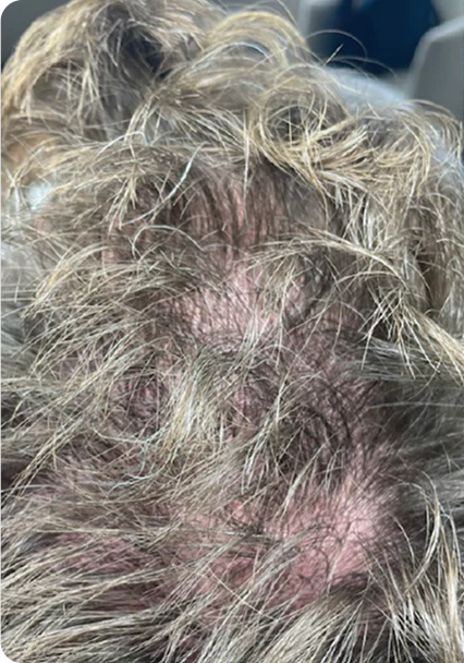 Male crown — before