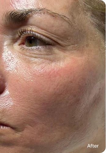 Fine lines — after HydraFacial