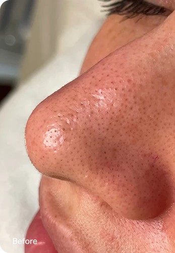 Congestion & pores — before