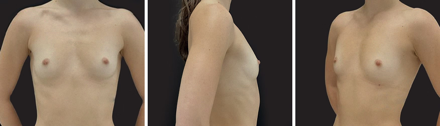 Before Mia femtech medical breast augmentation procedure 4