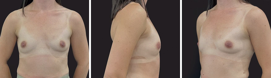 Before Mia femtech medical breast augmentation procedure 5