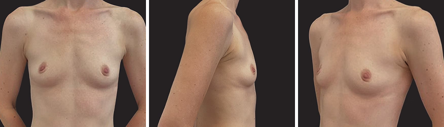 Before Mia femtech medical breast augmentation procedure