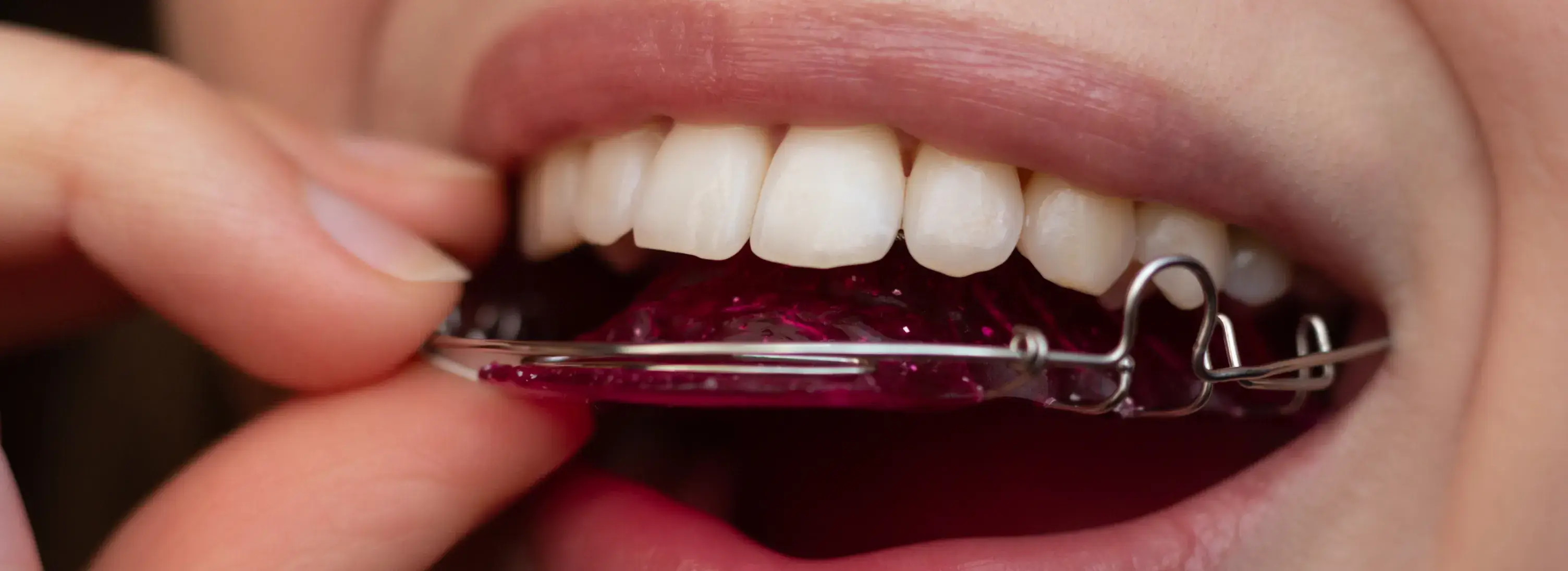 A close up of a person holding a dental retainer
