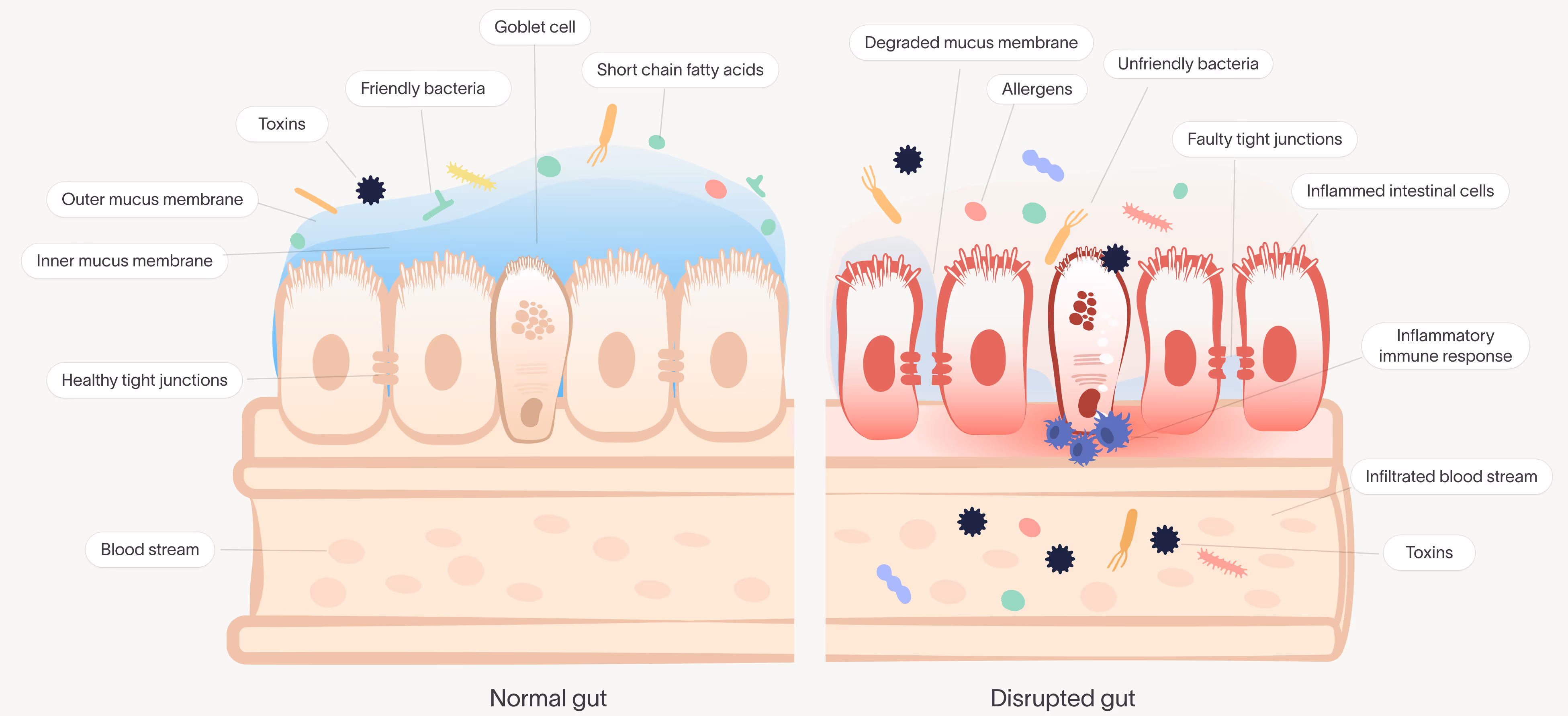 Side-by-side illustration of a normal gut with healthy tight junctions and a disrupted gut lining with inflammation and toxins