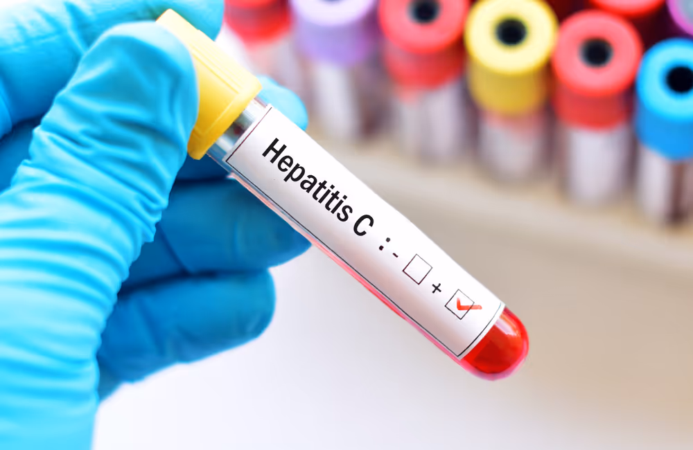Glove holding a test tube labelled Hepatitis C