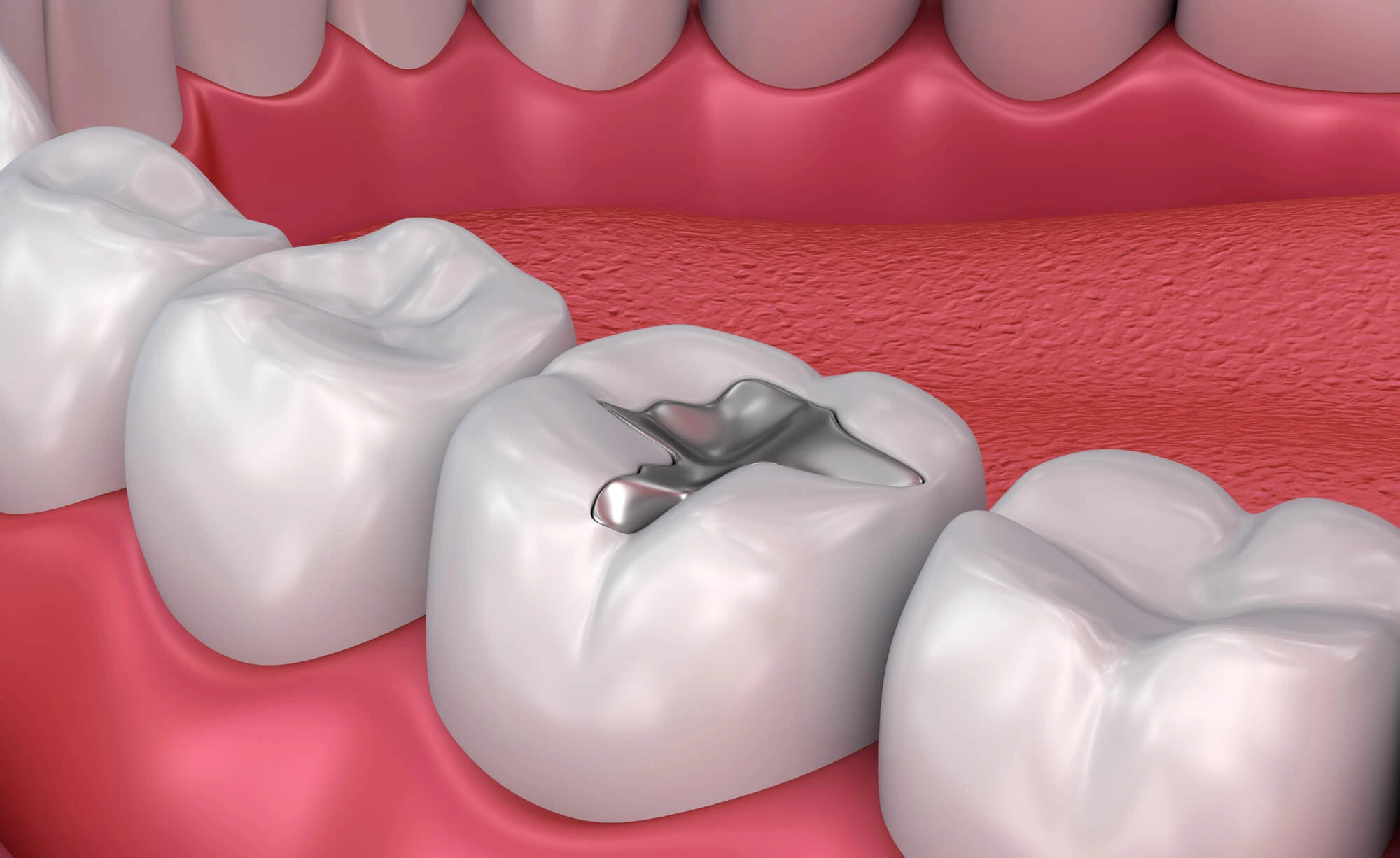 Tooth Filling by dentist auburn