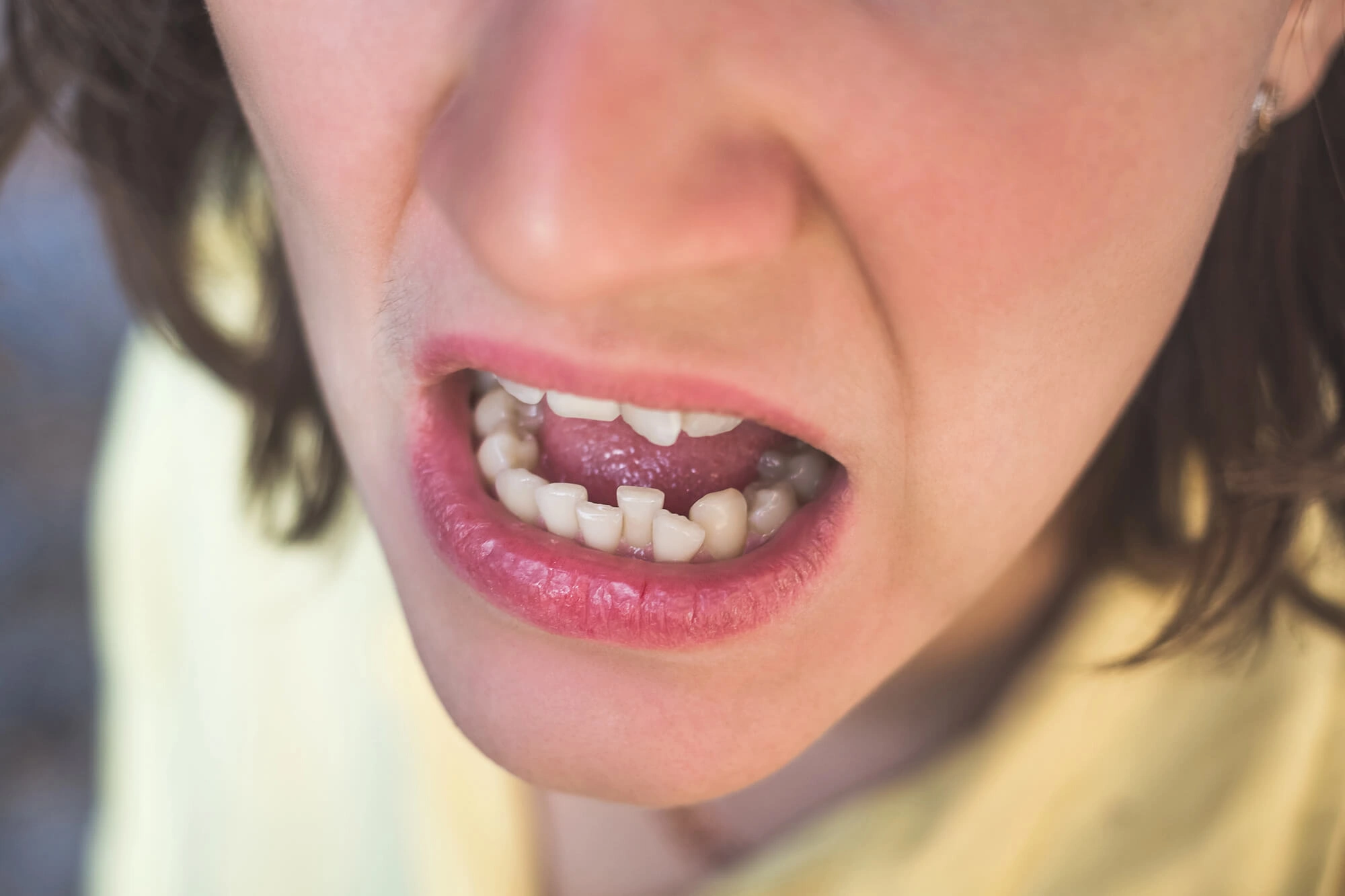 Crowded teeth needs orthodontist opelika al