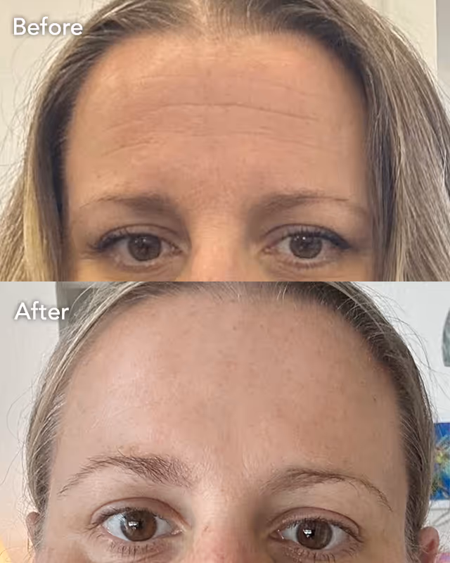 Botox