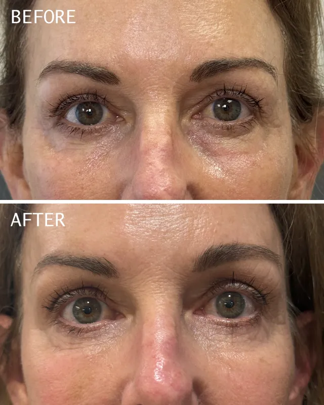 Botox