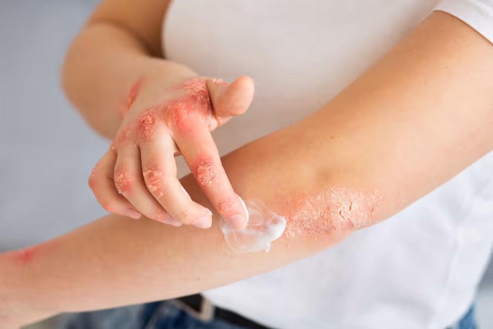 Patient applying topical cream to irritated rash.