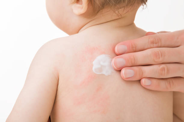 Dermatolofist rubbing ointment on a baby for eczema treatment.