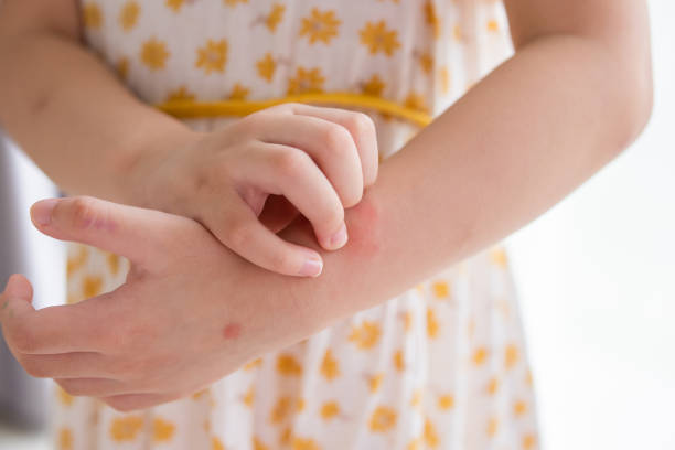 Child itching rash on arm.