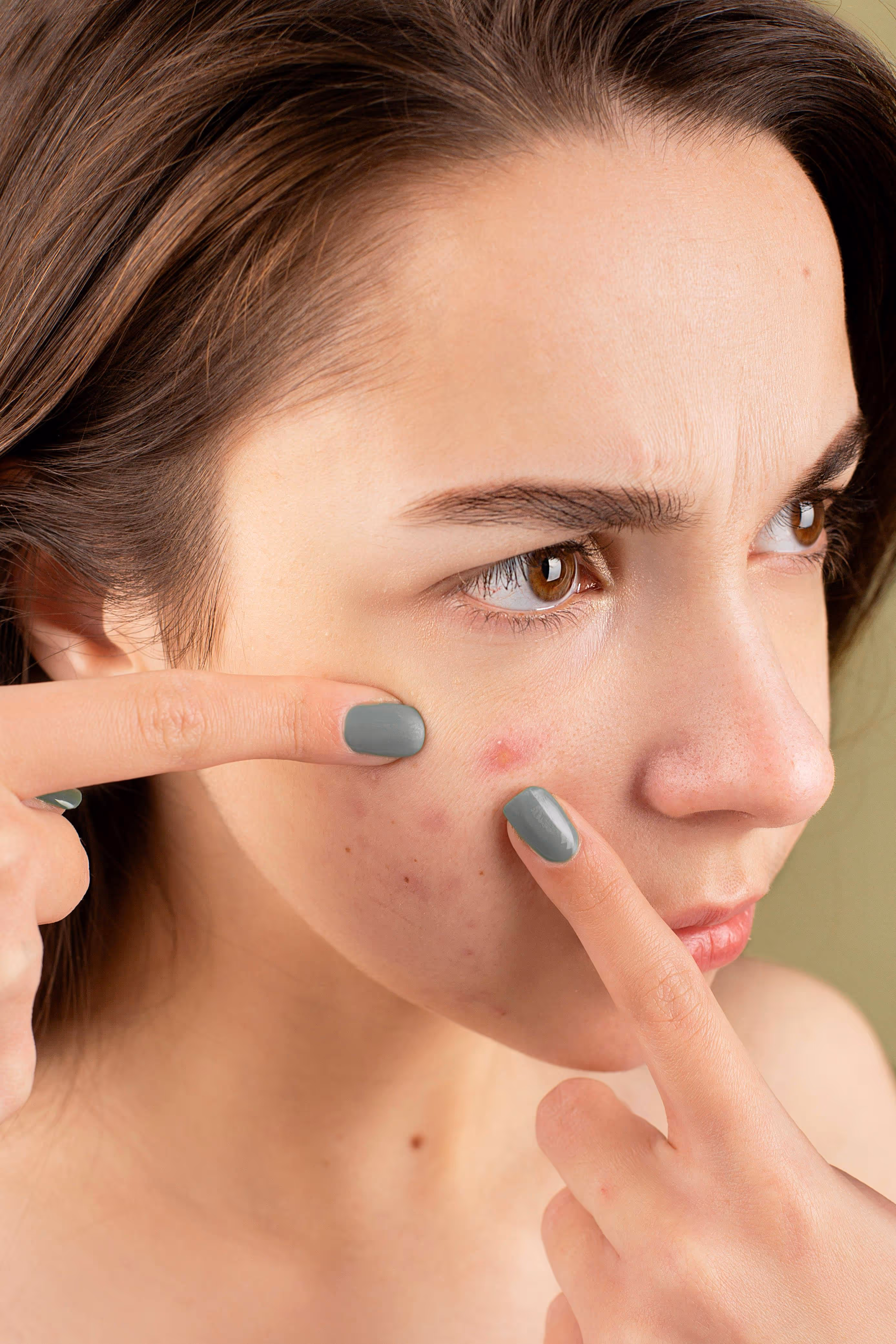 Teenager with acne on face. 