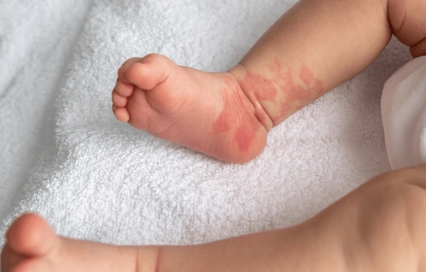 Baby born with birthmarks on foot.