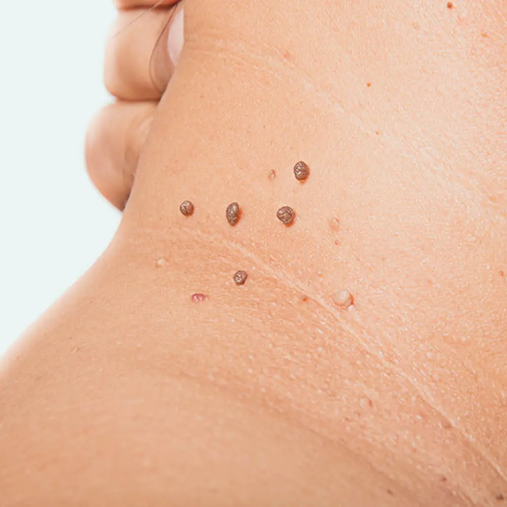 Skin tag growth on a dermatology patient.