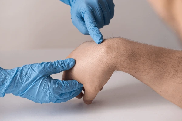 Skin tag growth on a dermatology patient.