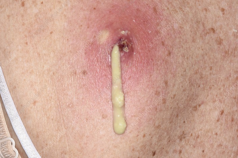Electrosurgery on a skin tag.