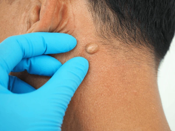 Skin tag growth on a dermatology patient.