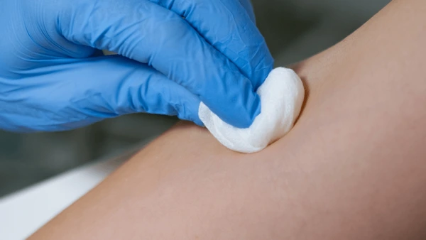 Woman applies topical treatment to rosacea irritation. 