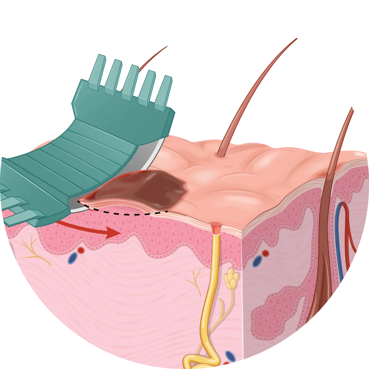 Medical illustration of a shave biopsy showing a blade removing the top layer of skin tissue.