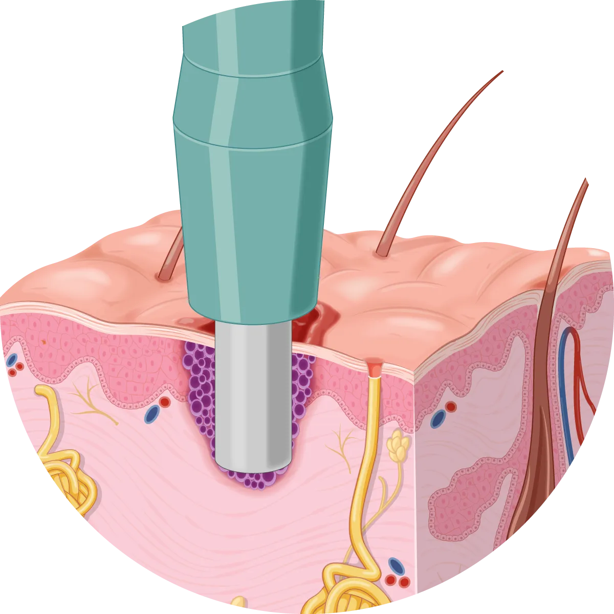 Medical illustration of a punch biopsy showing a circular tool extracting a deeper core of skin tissue through multiple layers.