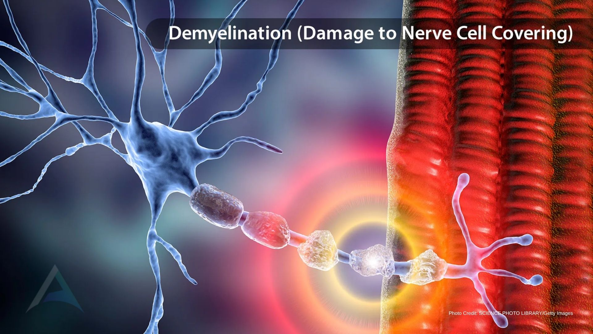 intentional daily care strategies for managing multiple sclerosis with nervous system support