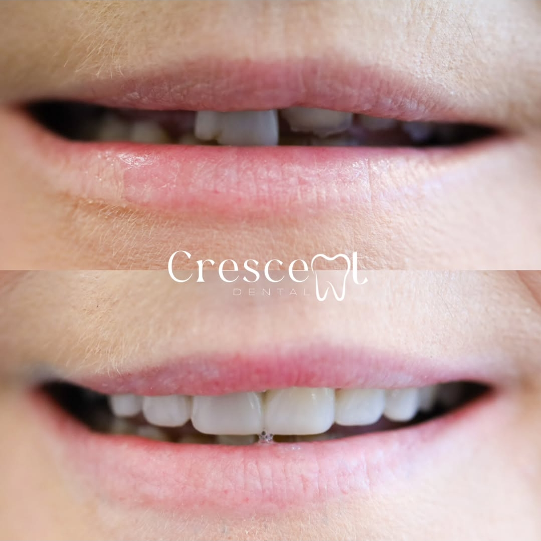 Before and after close-up of a person's smile showing dental improvement with repaired and whitened teeth.