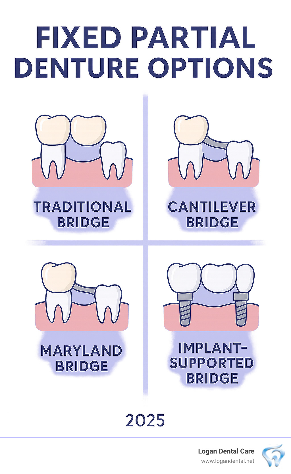 Partial to Dentures? Your Guide to Fixed Partial Denture Options