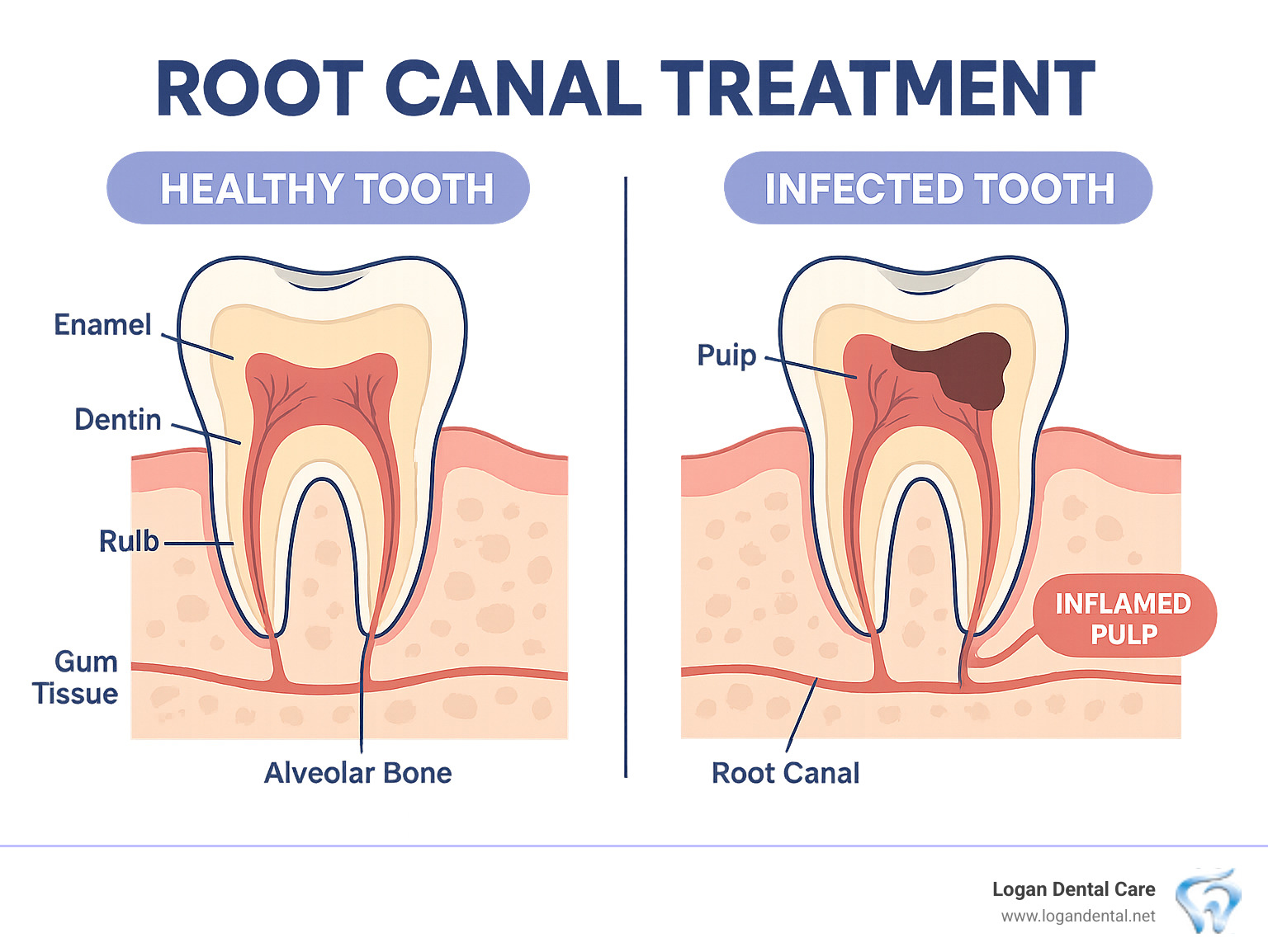 Comprehensive infographic showing a cross-section comparison of a healthy tooth versus an infected tooth needing root canal treatment, including labeled anatomy of tooth pulp, root canals, and surrounding tissues, plus visual indicators of infection symptoms - root canal treatment infographic 