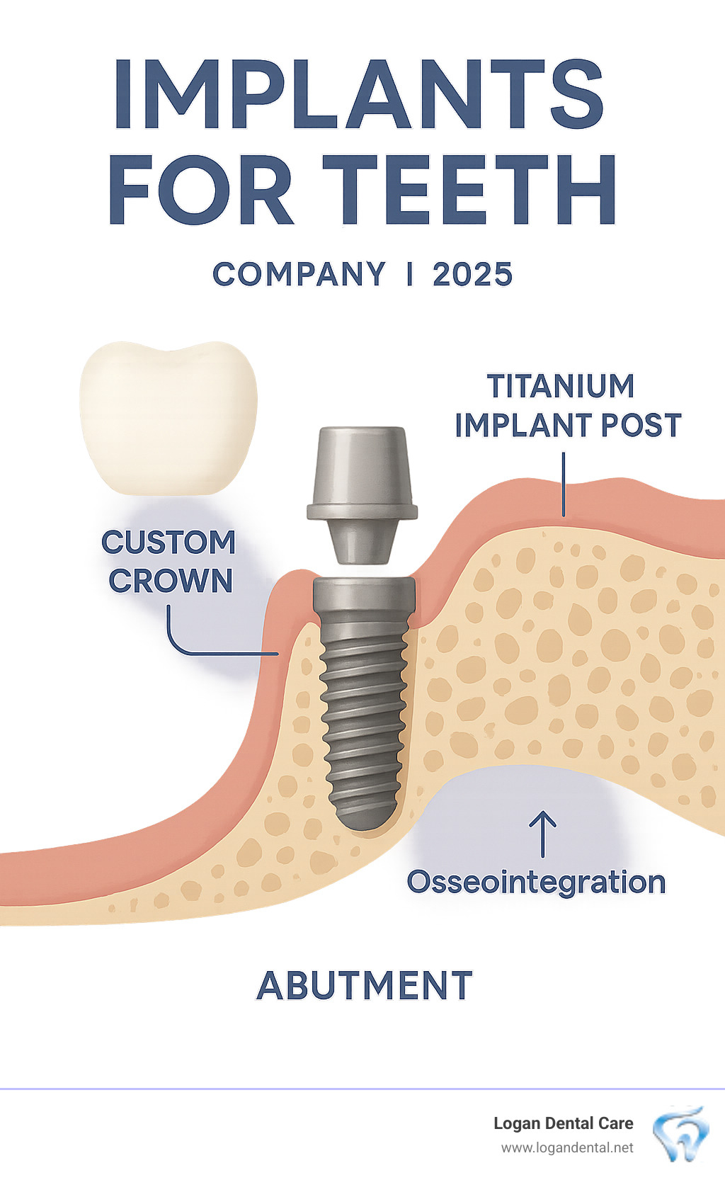 Detailed infographic showing the three components of a dental implant system: the titanium implant post surgically placed in the jawbone, the abutment connector piece that extends through the gum line, and the custom crown that matches surrounding teeth, with labels and cross-section view of how osseointegration occurs - implants for teeth infographic 