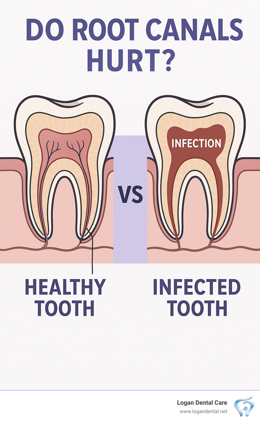 Infographic showing a cross-section comparison of a healthy tooth versus an infected tooth requiring root canal treatment, with labels indicating the pulp, nerve, and areas of infection - do root canals hurt infographic 