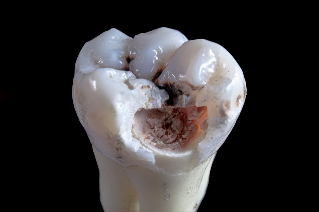 Diagram showing a cracked molar with internal layers exposed - half broken molar tooth repair Diagram showing a cracked molar with internal layers exposed - half broken molar tooth repair