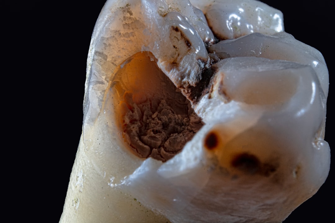 A close-up of a cracked molar requiring urgent repair - emergency dental near me open now within 5 mi A close-up of a cracked molar requiring urgent repair - emergency dental near me open now within 5 mi