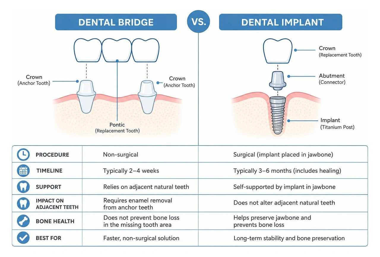 Comparison diagram of dental bridge vs dental implant Comparison diagram of dental bridge vs dental implant