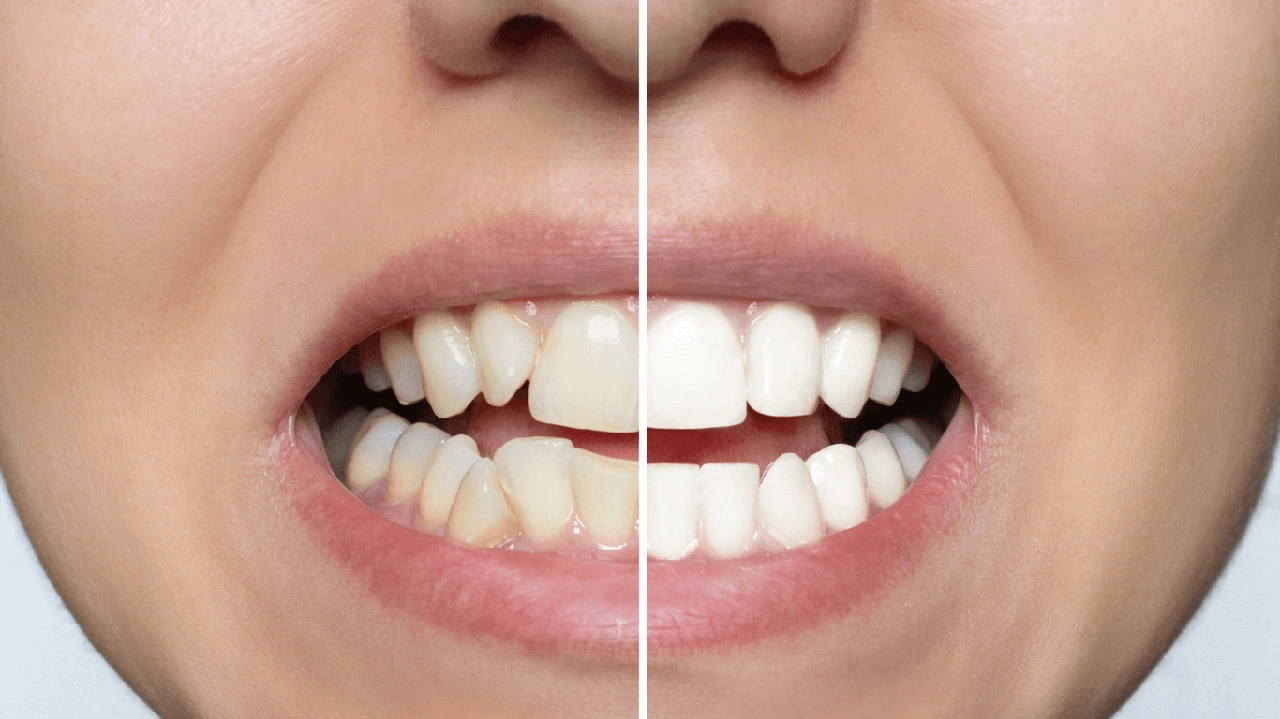 dental gel ingredients and enamel cross section dental gel ingredients and enamel cross section