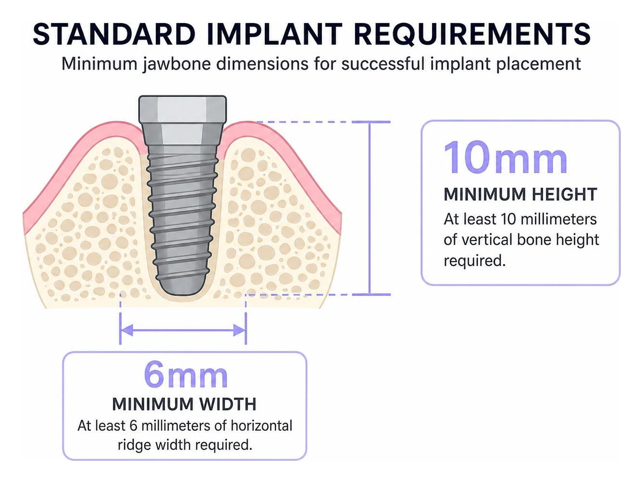 Diagram showing 10mm height and 6mm width standard implant requirements Diagram showing 10mm height and 6mm width standard implant requirements