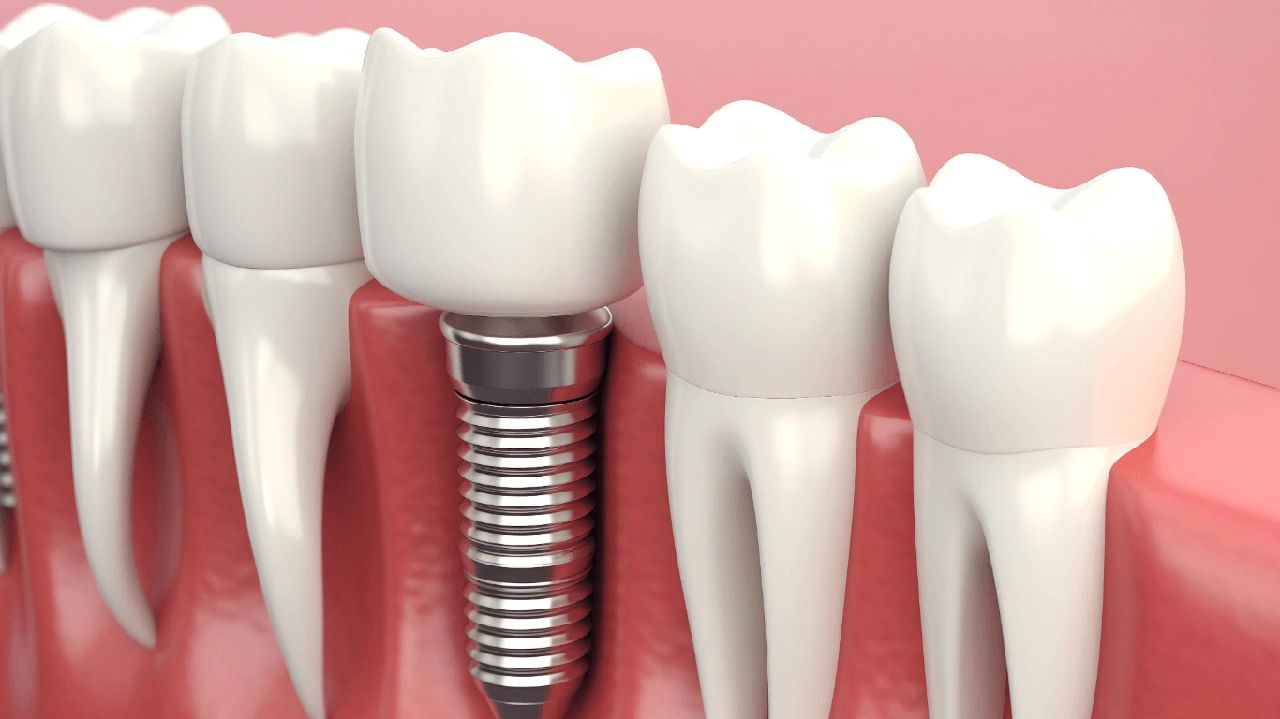 Single tooth implant structure compared side by side with a fixed dental bridge