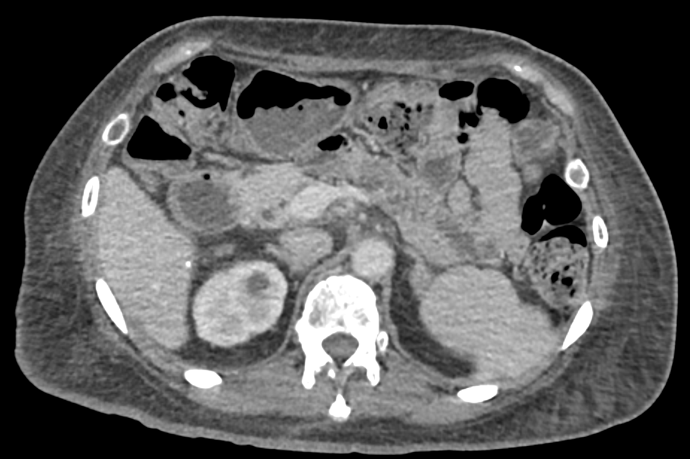 Figure 2: axial abdominal CT, one scan in a longitudinal series used to follow treatment response over time.