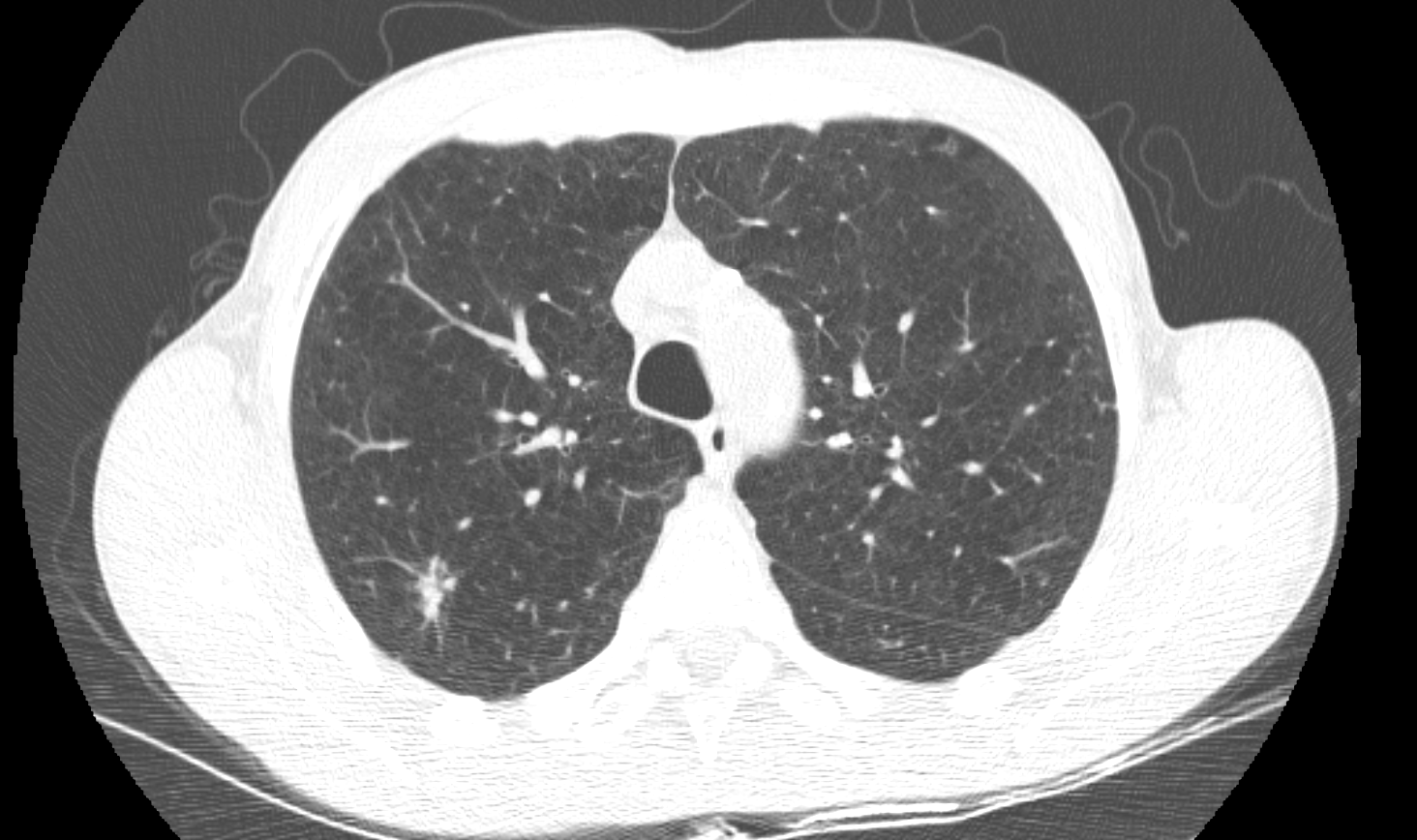 Figure 3: screening chest CT, followed through repeat imaging and pathology.