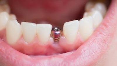 Dental Implant Encinitas CA