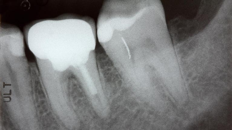 Dental Cleaning Encinitas CA