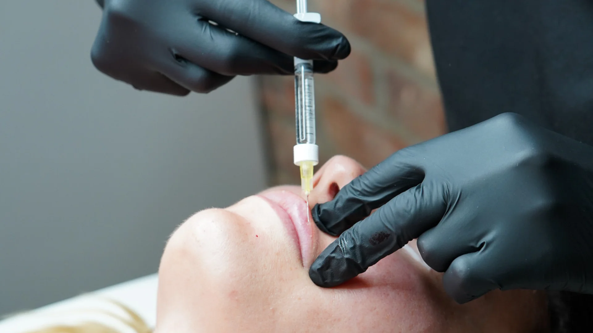 Rosie from GLO carefully administering a polynucleotide injection around a client’s lips during treatment.