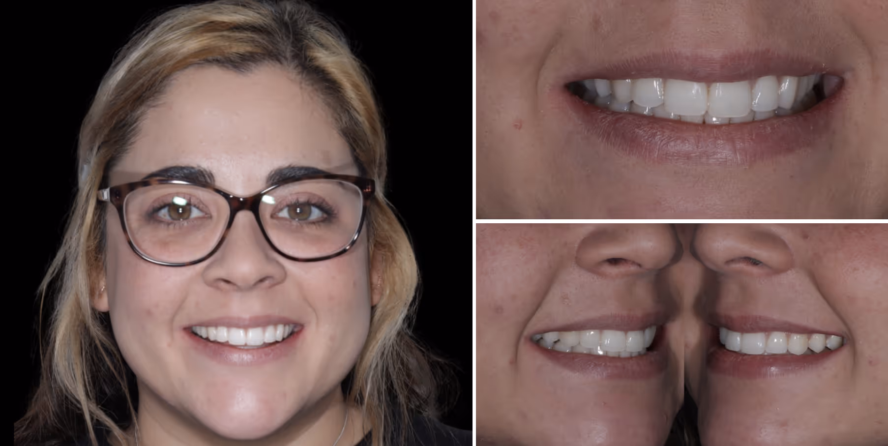 Invisalign result
