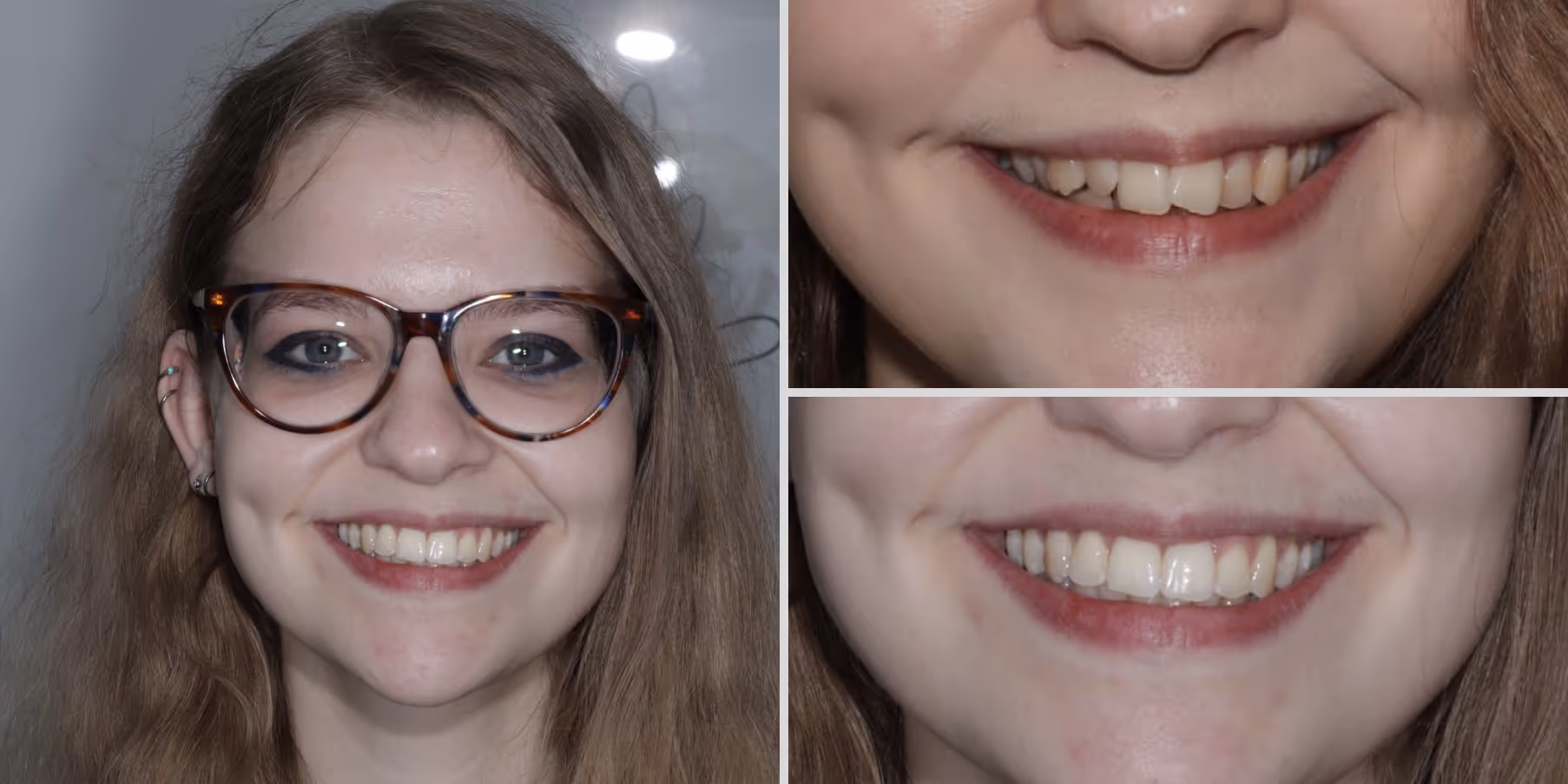 Teeth straightening with invisalign