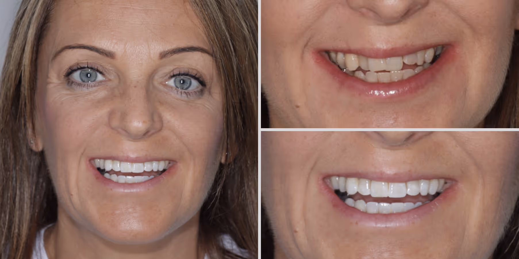 Teeth straightening with invisalign and teeth whitening