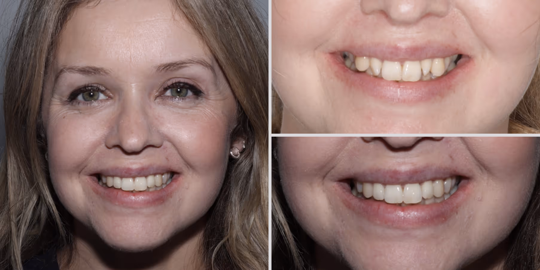 Teeth straightening