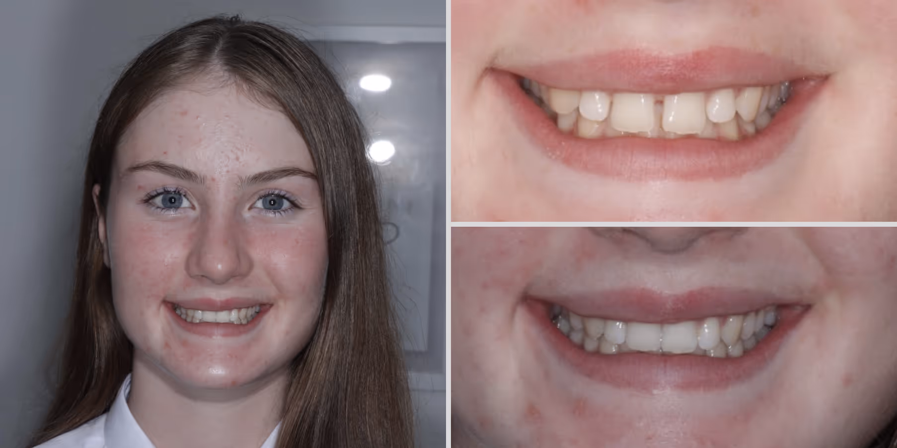 Teeth straightening with invisalign