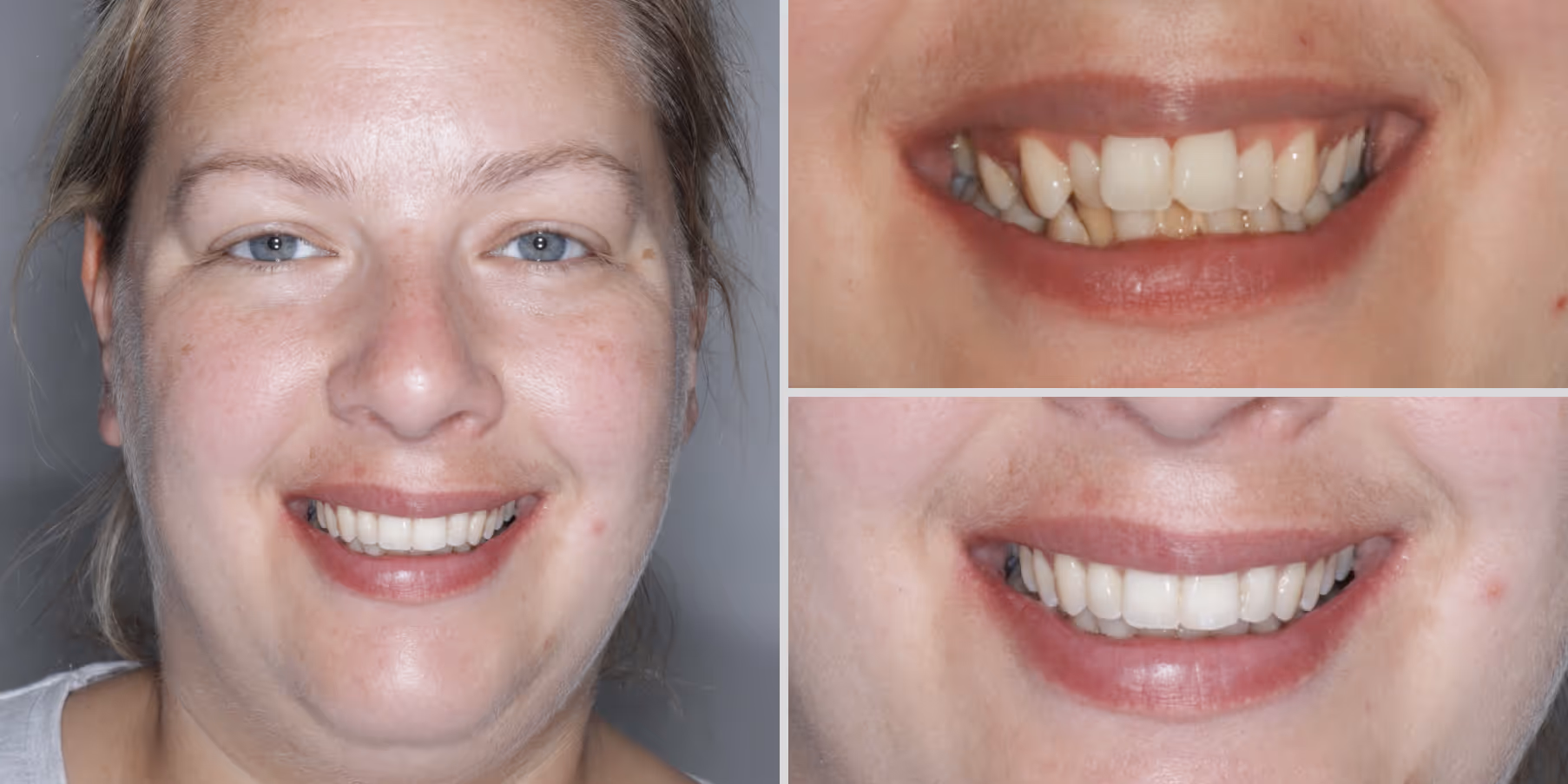 Teeth straightening with invisalign